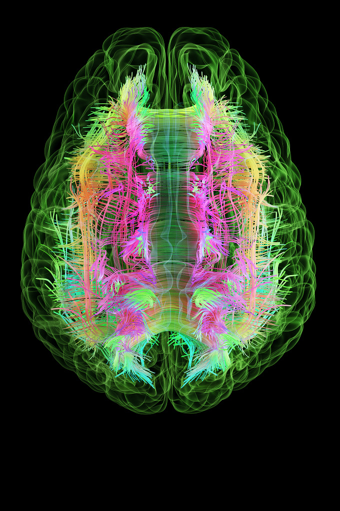 Colorful medical brain scan showing neural fiber pathways with green brain outline and vibrant pink, yellow, and cyan tract visualization