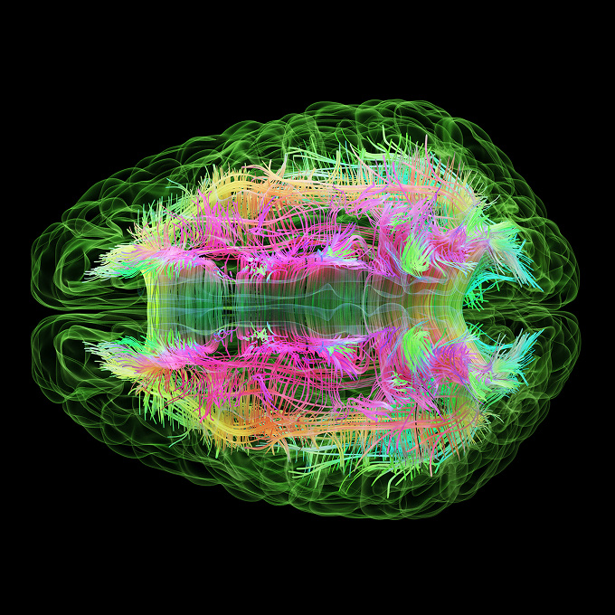 3D visualization of brain neural pathways with colorful fiber tracts in pink, green, and yellow against black background.